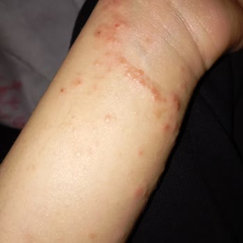 İzmir Bayraklı Şehir Hastanesi Dermatoloji Bölümünde Yanlış Teşhis Ve Zararlı Tedavi