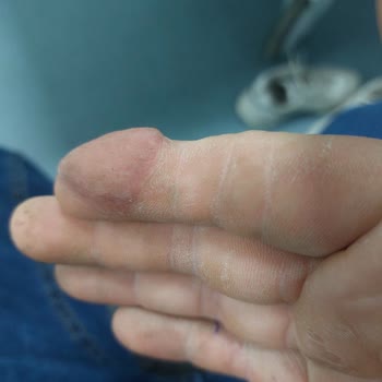 İş Kazası Sonrası Ücretsiz Ek Ameliyat Ve Randevu Sorunları İçin Açık Bilgilendirme Talebi