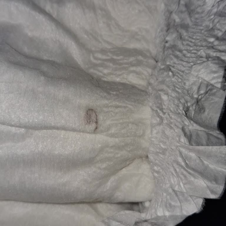 Yabancı Madde İçeren Bebek Bezinde Tekrarlayan Cilt Tahrişi