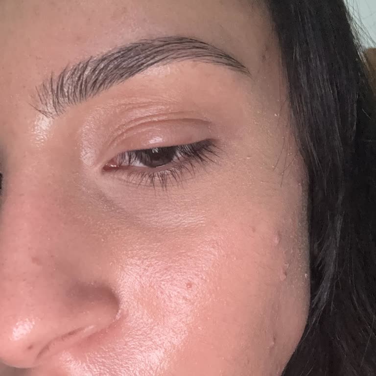 Hijyen İhlali Sonrası Göz Enfeksiyonu Ve Ücret İadesi Talebi