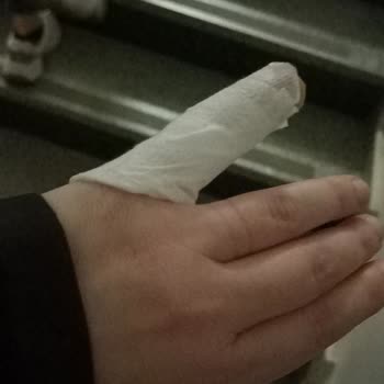 Şoförün Dikkatsiz Hızlı Sürüşü Nedeniyle Bacağım Şişti Ve Taksi Masrafı Ödedi