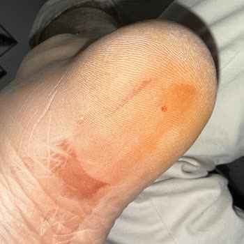 Adidas Mağazasında Alarm İğnesi Yaralanmaya Yol Açtı