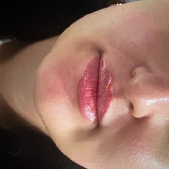 20.000 TL'lik Sıvı Yüz Germe Şiş Ve Asimetrik Çıktı, Klinik Çözüm Ve İade Talep Ediyor