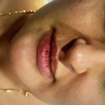 20.000 TL'lik Sıvı Yüz Germe Şiş Ve Asimetrik Çıktı, Klinik Çözüm Ve İade Talep Ediyor