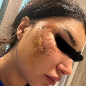 Acıbadem Taksim Hastanesi'nde Endoskopik Kaş Kaldırma Sonrası Ciddi Enfeksiyon Ve Tazminat Talebi