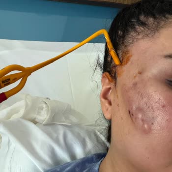 Acıbadem Taksim Hastanesi'nde Endoskopik Kaş Kaldırma Sonrası Ciddi Enfeksiyon Ve Tazminat Talebi