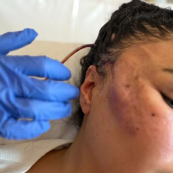 Acıbadem Taksim Hastanesi'nde Endoskopik Kaş Kaldırma Sonrası Ciddi Enfeksiyon Ve Tazminat Talebi