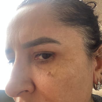 Yanıltıcı Ödeme Ve Estetik İşlem Sonrası Sağlık Sorunları Nedeniyle 111.000 TL İadesi Talebi