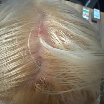 Saç Boyası Kullanımında Şiddetli Yanma Ve Kanama