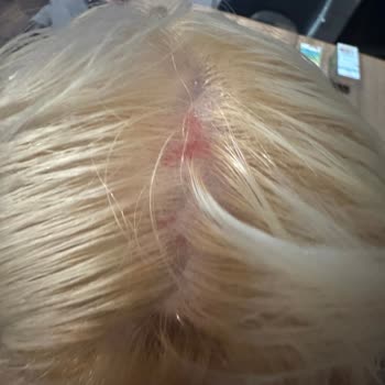 Saç Boyası Kullanımında Şiddetli Yanma Ve Kanama