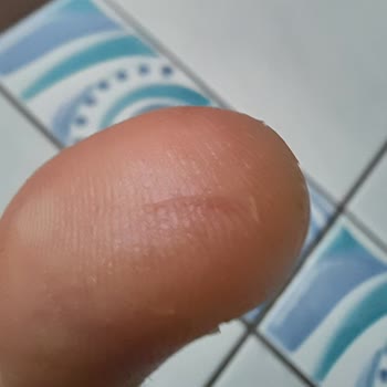 Kızılay Soda Cam Şişede Kapağın Kopması Parmak Kesilmesine Neden Oldu