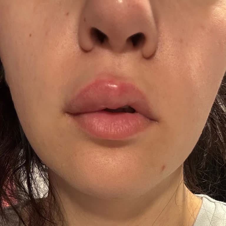 Dudak Dolgu Uygulaması Sonrası Kalıcı Şişlik Ve Sağlık Riski