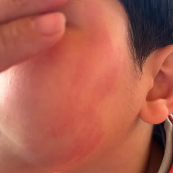 Dalin Atocure Losyon Şampuanı İlk Kullanımda Bebek Cildinde Kızarıklık Ve Ücret İadesi Talebi