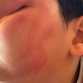 Dalin Atocure Losyon Şampuanı İlk Kullanımda Bebek Cildinde Kızarıklık Ve Ücret İadesi Talebi