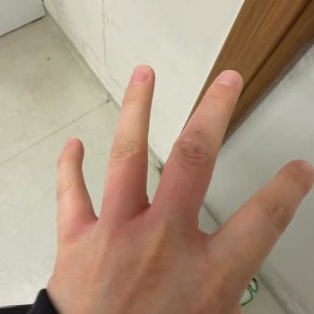 Stanley Termos Patlaması Sonrası Ciddi Yanık ve Güvenlik Riski