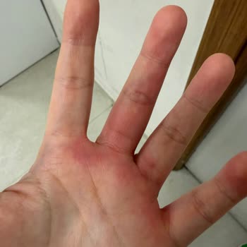 Stanley Termos Patlaması Sonrası Ciddi Yanık ve Güvenlik Riski