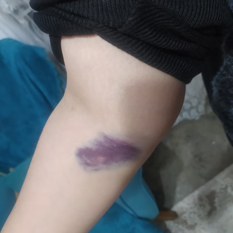 Serum Takılması Sonrası Şiddetli Kol Şişmesi Ve Morarması