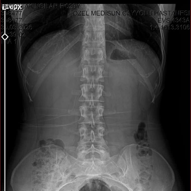 Kuyruk Sokumuma Röntgen Çekilmedi, Yanlış Tanı