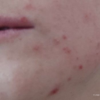 Bee Beauty Pirinç Peeling Kullanımından Sonra Yüzde Yanma Ve Küçük Yaralar