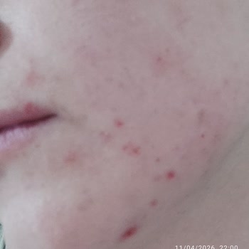 Bee Beauty Pirinç Peeling Kullanımından Sonra Yüzde Yanma Ve Küçük Yaralar