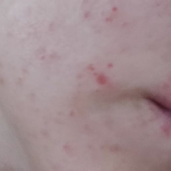 Bee Beauty Pirinç Peeling Kullanımından Sonra Yüzde Yanma Ve Küçük Yaralar