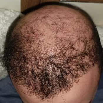 Serkan Aydın Saç Ekimi Sonrası Kötü Görünüm Ve Sözlerin Tutulmaması