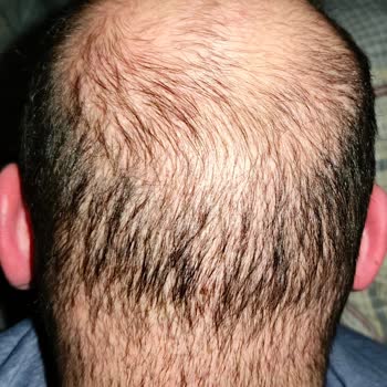 Serkan Aydın Saç Ekimi Sonrası Kötü Görünüm Ve Sözlerin Tutulmaması