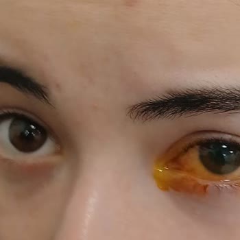 Sparx Deterjan Tabletinin Göze Sıçraması Ve Şiddetli Ağrı