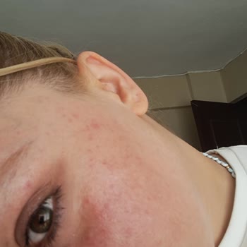 Mustela Güneş Kremi Ciltte Alerjik Reaksiyon Ve İade Talebi