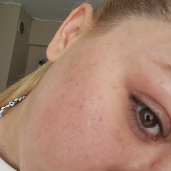 Mustela Güneş Kremi Ciltte Alerjik Reaksiyon Ve İade Talebi