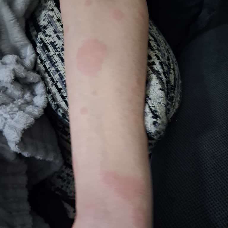 Pharmaton İlacına Alerjik Reaksiyon Ve İade Talebi