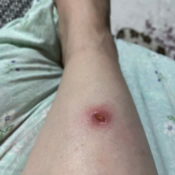 Philips IPL Cihazı Kullanırken Aldığım Ciddi Yanık Ve Kalıcı İz