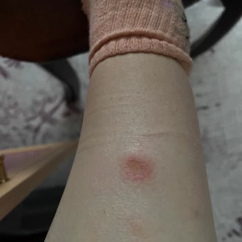 Philips IPL Cihazı Kullanırken Aldığım Ciddi Yanık Ve Kalıcı İz