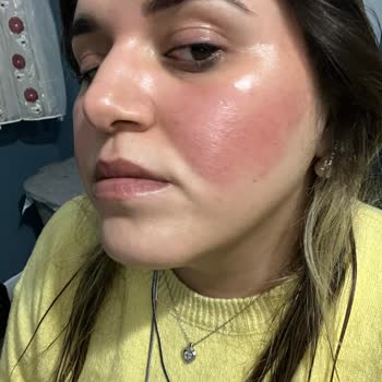 Flormar Allığı Cilt Tahrişi Nedeniyle İade Talebi