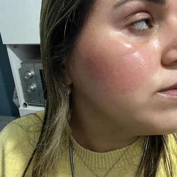 Flormar Allığı Cilt Tahrişi Nedeniyle İade Talebi