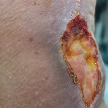 Kötü Sonuçlanan Estetik Ameliyatlar Ve Aşırı Ücretli Düzeltme İçin İade Talebi