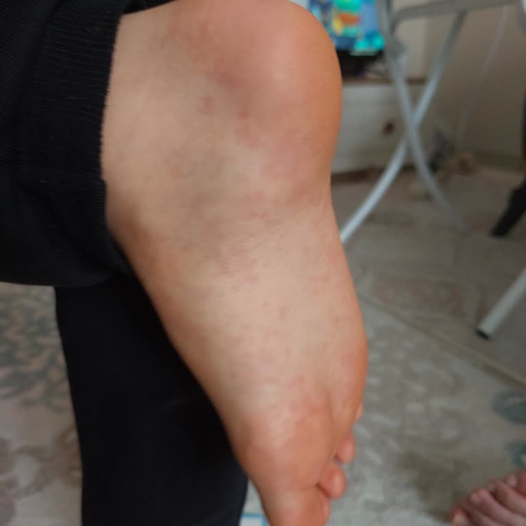 Argivit Fokus Şurupta Görülen Döküntüler Nedeniyle Ücret İadesi Talebi