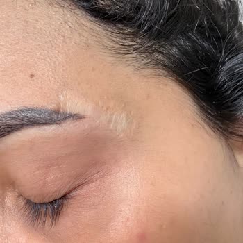 Kaş Kaldırma Sonrası Kalıcı İzler Ve Yetersiz Tazminat Şikayeti