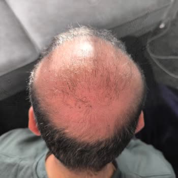 Mega Hair Trans'ta Saç Ekimi Sonuçsuzluğu Ve İade Talebi