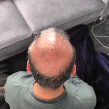 Mega Hair Trans'ta Saç Ekimi Sonuçsuzluğu Ve İade Talebi