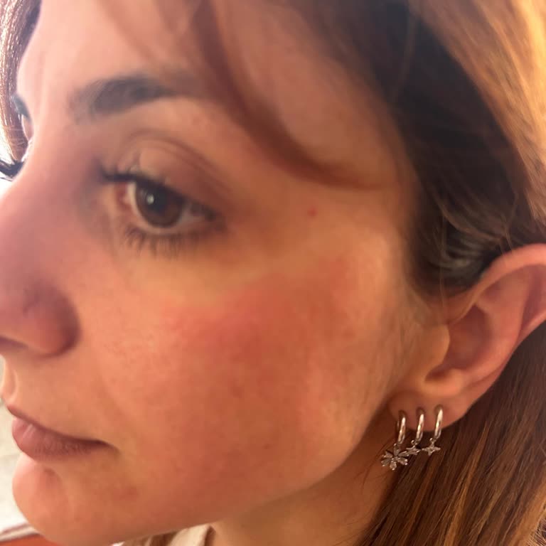 L’Oreal Güneş Kremi Şiddetli Tahriş Yaratıyor, Müşteri Hizmetleri Yanıt Vermiyor