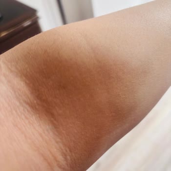 Yanlış Enjeksiyon Sonucu Kalıcı Leke Ve Lazer Tedavi Masrafı Hastane Tarafından Karşılanmalı