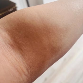 Yanlış Enjeksiyon Sonucu Kalıcı Leke Ve Lazer Tedavi Masrafı Hastane Tarafından Karşılanmalı