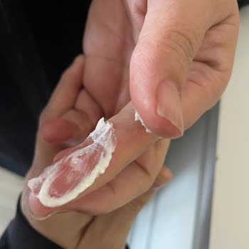 Suna Luxury Ankara’da Hassas Cilt Bakımı Sonrası Yanan Cilt Ve Bozuk Ürün İçin Ücret İadesi Talebi