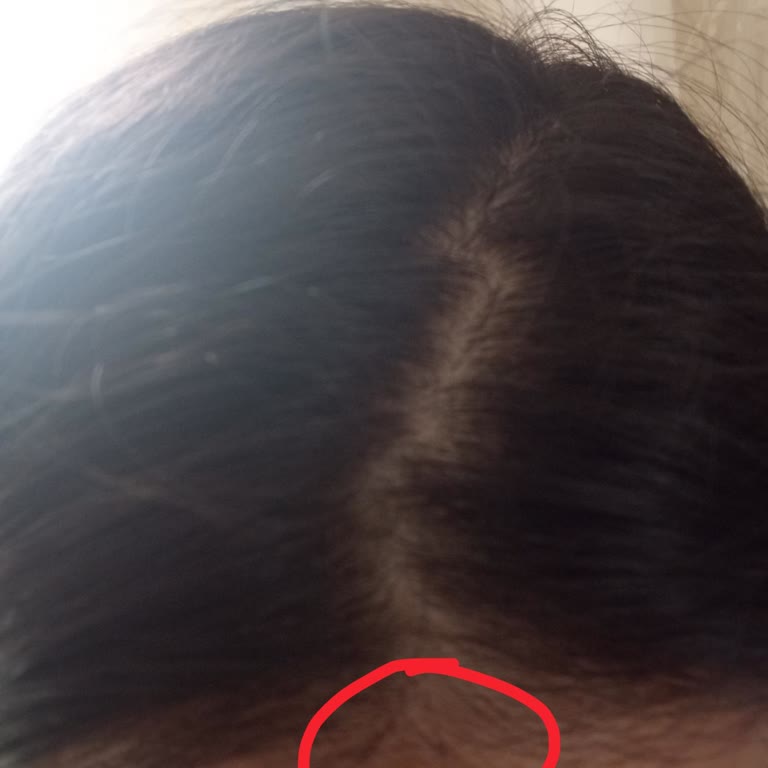 Urban Care Şampuanı İlk Kullanımda Saç Derisinde Ve Yüzde Sivilce Oluştu