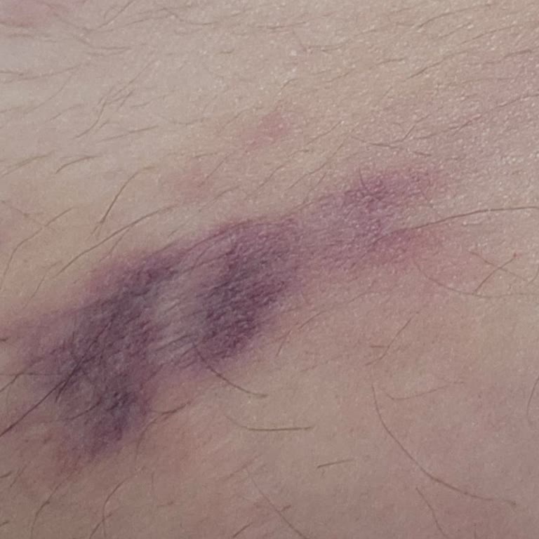 Deluxe Vip Güzellik Salonu'nda Bölgesel İncelme Sonrası Şiddetli Morarma Ve Yürüme Güçlüğü