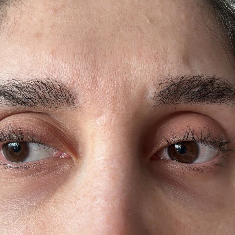 Kaş Ve Kirpik Liftinginde Yanma Sonucu Kalıcı Hasar