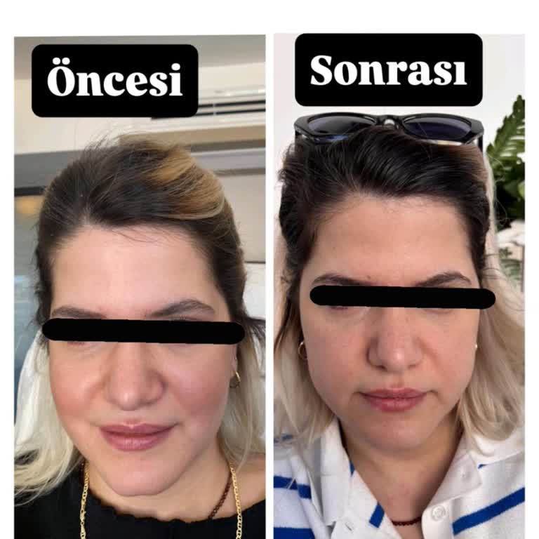 İkbal Demirtaş Estetik İşlem Sonrası Mağduriyet