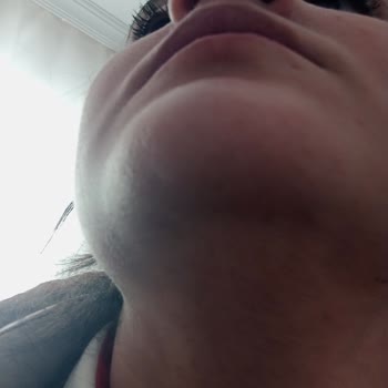 Yüz Lazer Epilasyonda Söz Verilen %80 Azalma Sağlanmadı, Personel Sürekli Değişti