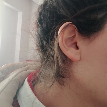 Yüz Lazer Epilasyonda Söz Verilen %80 Azalma Sağlanmadı, Personel Sürekli Değişti